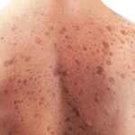 Cáncer de piel: dónde suelen aparecer los lunares peligrosos, cómo reconocerlos y quiénes deben cuidarse más